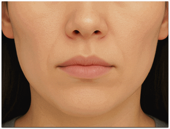 Jamsil Lifting: Not Sure Which Treatment to Choose? image 6