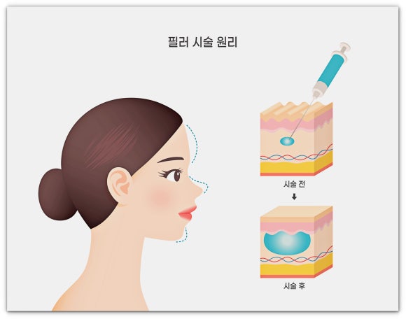 잠실역필러 잘하는 곳? 뭘 보고 결정해야 할까? 관련 이미지 4