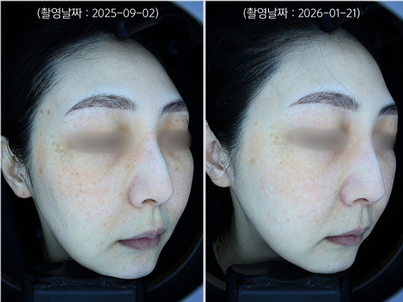Jamsil Laser Toning: A Case of Treating Dark Spots Around the Eyes and Facial Redness image 5