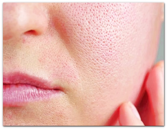 Seokchon Station Dermatology Treatment: What Are the Methods for Pore Elasticity and Sebum Control? image 2