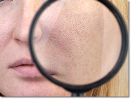 Why Is Exosome Effective for Pore Reduction? image 1