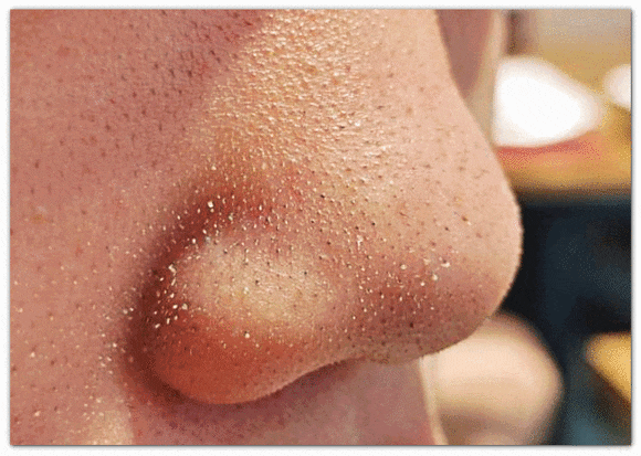 Seokchon Station Acne Dermatology Consultation, Symptoms, and Scar Type Classification: A Complete Summary image 2