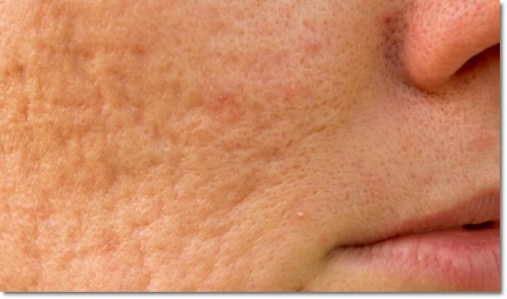 Why Is Exosome Effective for Pore Reduction? image 2