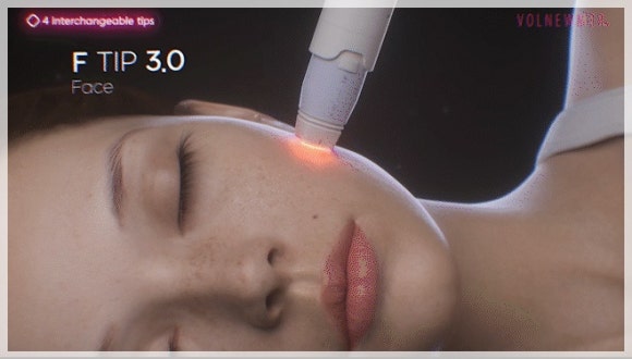 Jamsil Volnewmer Lifting Price, Effect, and How Long It Lasts image 3