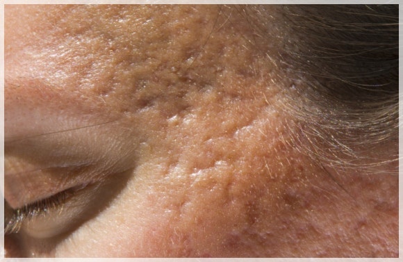 Jamsil Acne Scars: Can Depressed Marks Really Become Less Noticeable? image 4