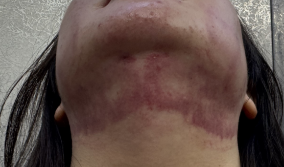 잠실온다리프팅 10만줄 통증 걱정된다면 관련 이미지 2