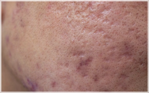 Jamsil Acne Scars: Can Depressed Marks Really Become Less Noticeable? image 2
