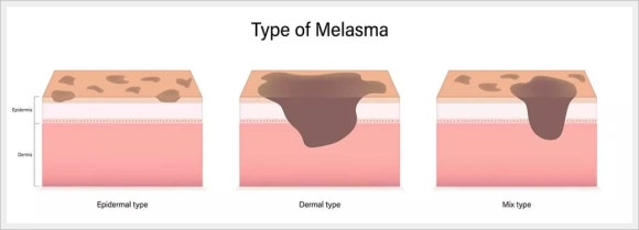 What You Need to Know About Melasma Removal in Jamsil image 2