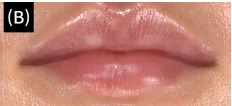 If You’re Curious About Lip Rejuran Side Effects and Effects image 1