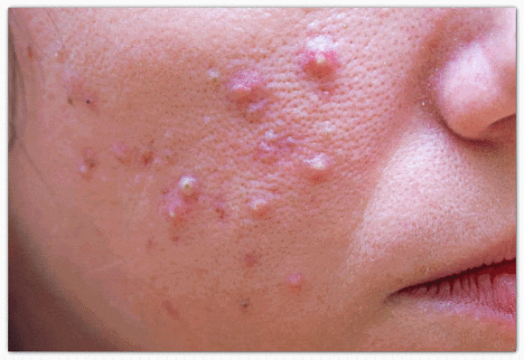 Seokchon Station Acne Dermatology Consultation, Symptoms, and Scar Type Classification: A Complete Summary image 1