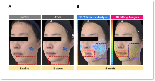 How Much Pain and Effect Does Volnewmer Have? image 5