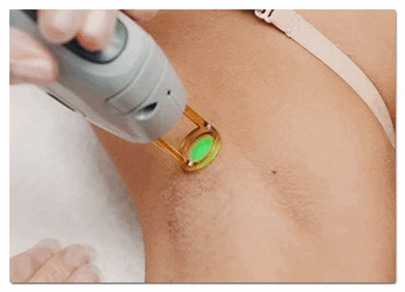 Jamsil Underarm Hair Removal: If Shaving Frequently Is a Hassle image 5
