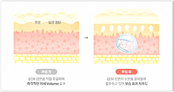 잠실리투오, 리쥬란과의 차이점? 뭘 받아야 할까? 관련 이미지 4