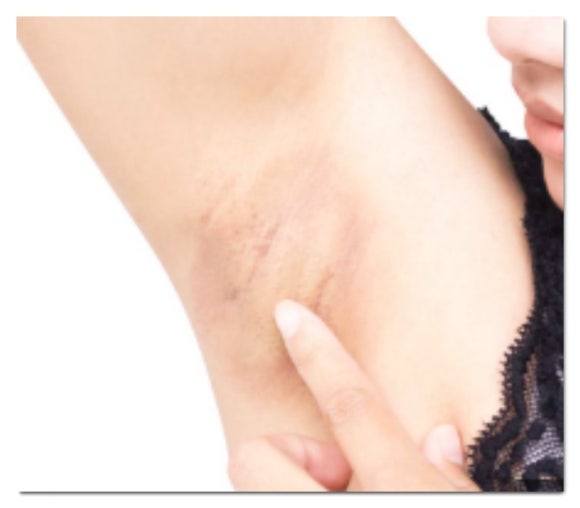 Jamsil Underarm Hair Removal: If Shaving Frequently Is a Hassle image 2