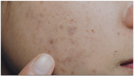 잠실여드름흉터 깊어도 치료 가능할까? 관련 이미지 3