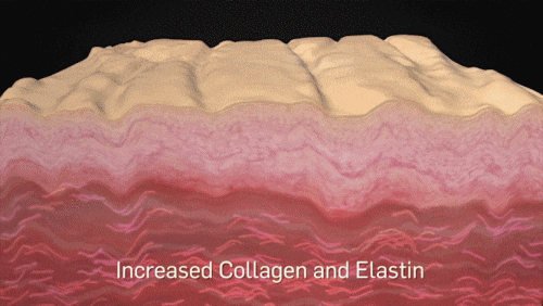 Jamsil Picosure Effects and Who It’s Recommended For (Including Tips to Lower the Cost) image 6