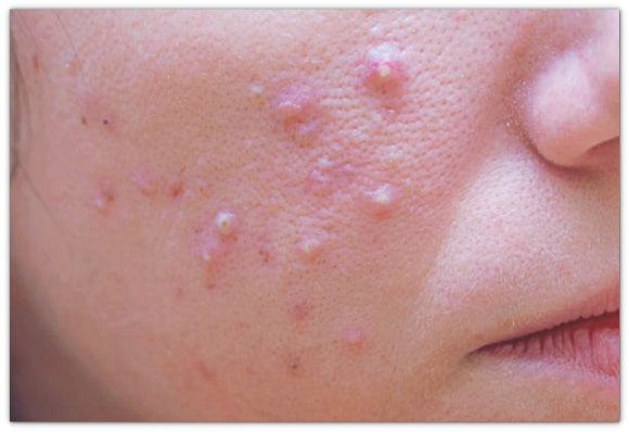 Acne Aquafill: Why Do Reviews About Its Effectiveness Differ? image 4