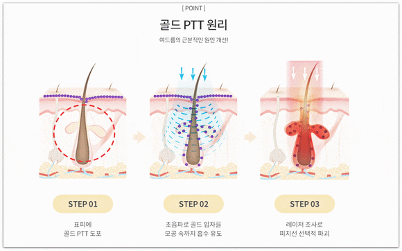 석촌역 여드름 피부과 진료 치료 방법과 종류는? 관련 이미지 7