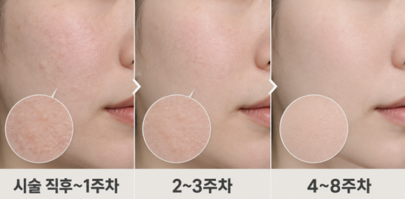잠실리투오, 기존 스킨부스터와 무엇이 다를까? 원리부터 효과까지 관련 이미지 6