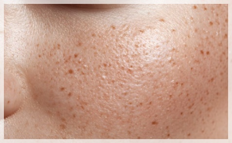 Jamsil Ruby Laser: Which Pigments Is It Effective For? image 3