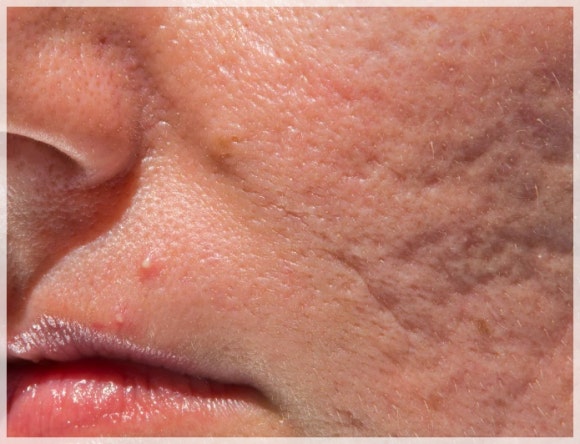 How Can Sunken Acne Scars in Jamsil Be Treated? image 2
