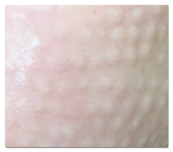 Comparison of Jamsil Rejuran Types and How to Reduce Pain image 7