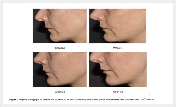 Belotero Revive Effects: Honestly, What Are They? image 4