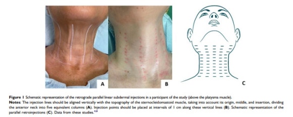 How much can Radiesse help with neck wrinkles? image 4