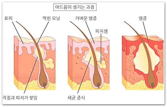 Seokchon Station Dermatology Treatment: What Are the Methods for Pore Elasticity and Sebum Control? image 6