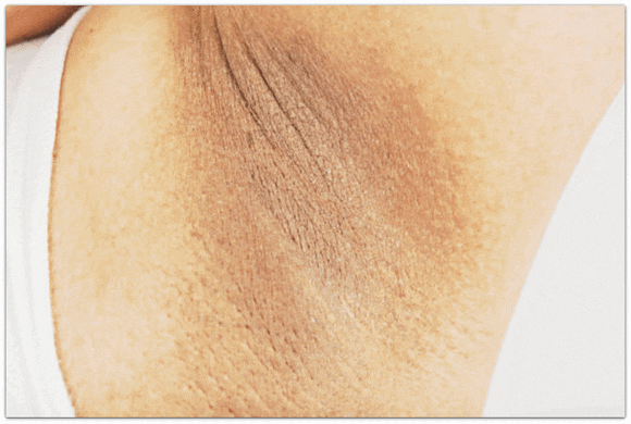 Underarm Toning Effects: How Do Idols Care for Their Underarms? image 5