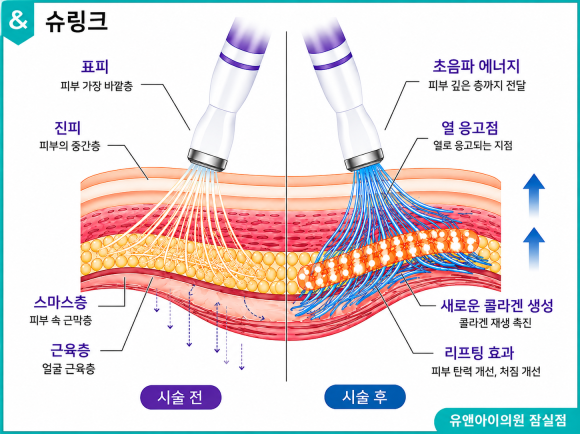 Jamsil Shurink, How Is It Different from Other Lifting Treatments? image 2