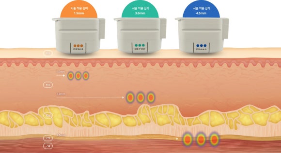 Songpa Ultherapy Lifting: Why the Procedure Is Performed While Viewing the Inside of the Skin image 4