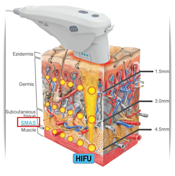 Jamsil Ulthera 300 Shots? 600 Shots? What Matters More Is <This> image 2