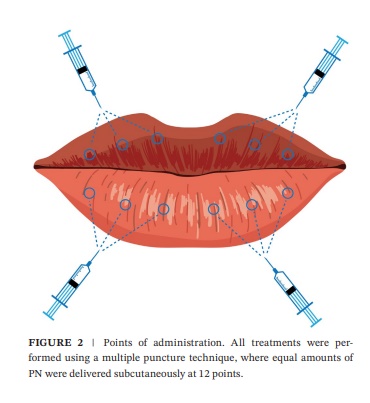 If You’re Curious About Lip Rejuran Side Effects and Effects image 2