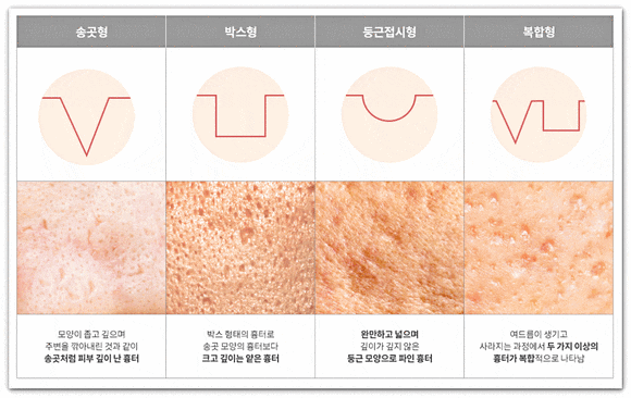Seokchon Station Acne Dermatology Consultation, Symptoms, and Scar Type Classification: A Complete Summary image 8