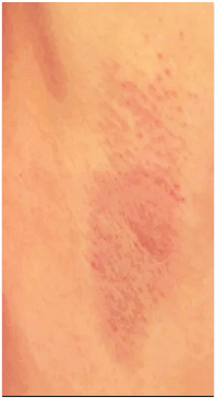 잠실역레이저제모 털 없애려다 화상 생겼다면? 관련 이미지 1