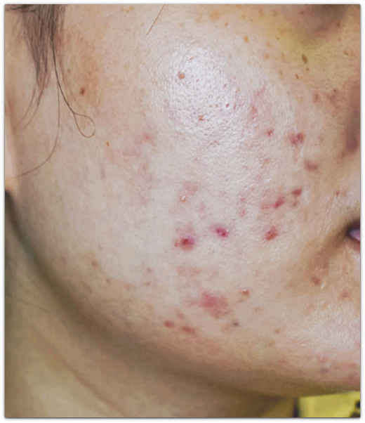 Seokchon-dong Dermatology Care: There Is a Specific Type That Benefits from ECM Skin Boosters image 8