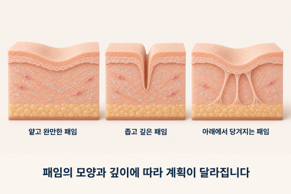 잠실 리쥬란 S, 패인 여드름 흉터에 효과 볼 수 있을까? 관련 이미지 6