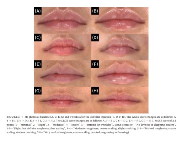 If You’re Curious About Lip Rejuran Side Effects and Effects image 5