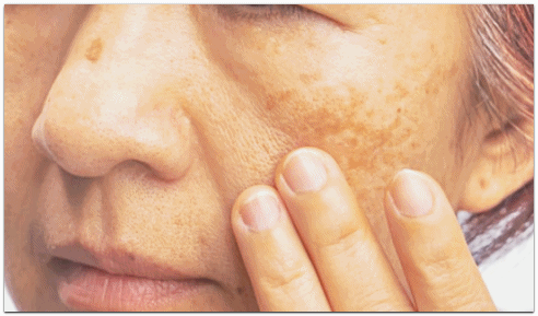 What Was the Reason Lase Toning in Jamsil Couldn’t Produce Results for Deep-Seated Melasma? image 4