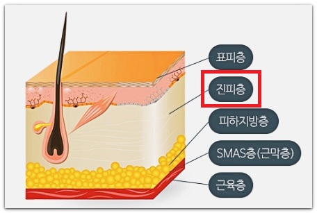 What Skin Types Is Jamsil Thermage Effective For? image 6