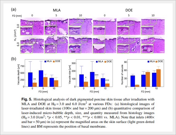 How Can Sunken Acne Scars in Jamsil Be Treated? image 5
