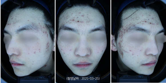 Jamsil Acne Dermatology Clinic: A Case of Treating Acne Pigmentation Scars image 2