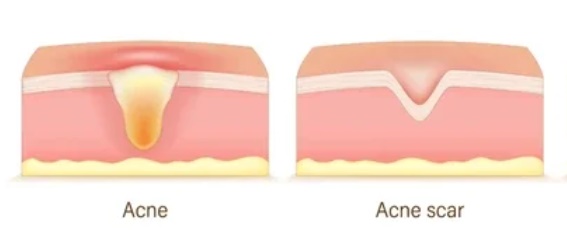Jamsil Acne Scars: Can Depressed Marks Really Become Less Noticeable? image 3