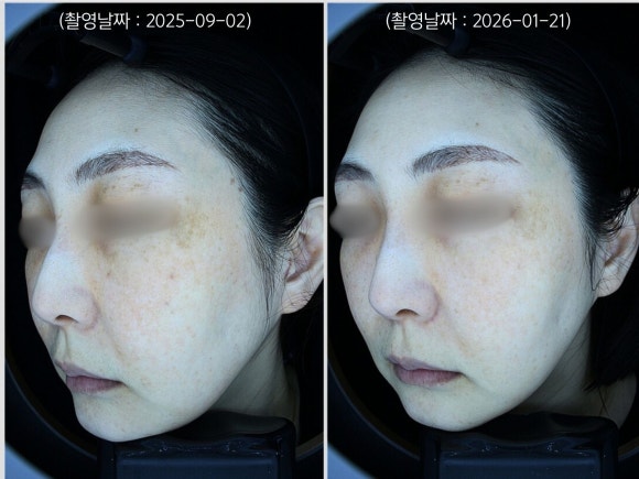 Jamsil Laser Toning: A Case of Treating Dark Spots Around the Eyes and Facial Redness image 4
