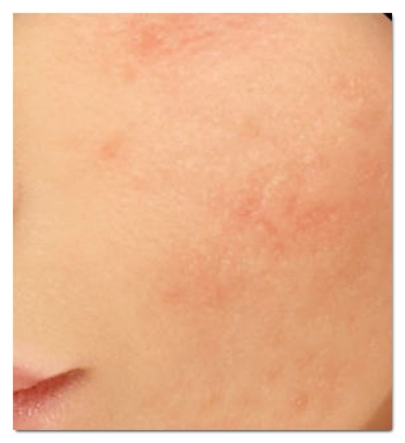 Jamsil Flat Warts: If You’re Confusing Them with Milia or Skin Tags image 4
