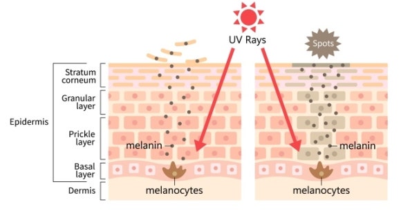 Jamsil Ruby Laser: Which Pigments Is It Effective For? image 2