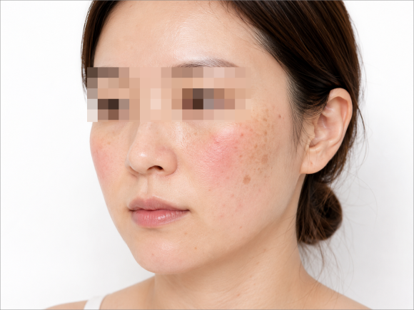 문정 피부과의원, 안면홍조와 기미 잡티가 고민이라면 관련 이미지 5