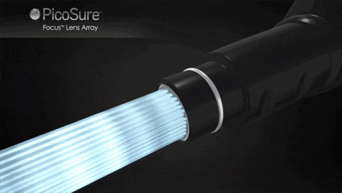 Jamsil Picosure Effects and Who It’s Recommended For (Including Tips to Lower the Cost) image 5