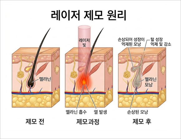 석촌역 피부과 제모 후기보다 중요한 관련 이미지 2